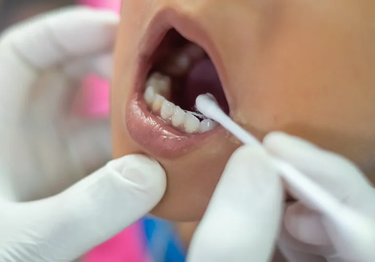 Times When Fluoride Treatment Is Most Effective